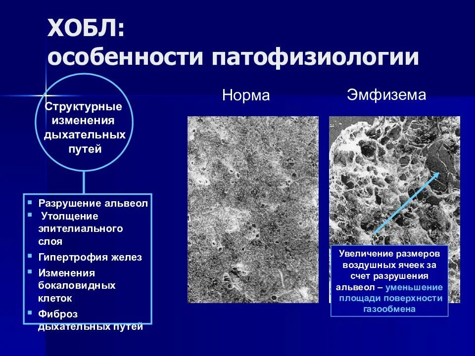 Морфологическая характеристика обструктивных заболеваний легких. Хроническая обструктивная болезнь легких.