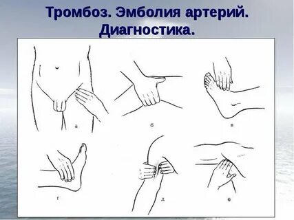 Дистальная артерия