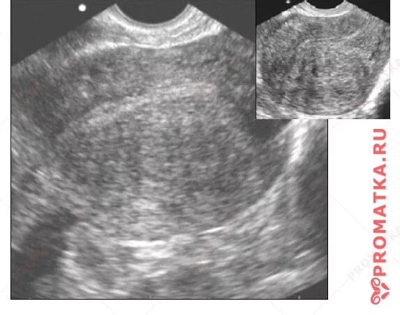 Признаки эндометриоза на узи что это. Узловая форма аденомиоза матки на УЗИ. Эндометриоз миометрия.