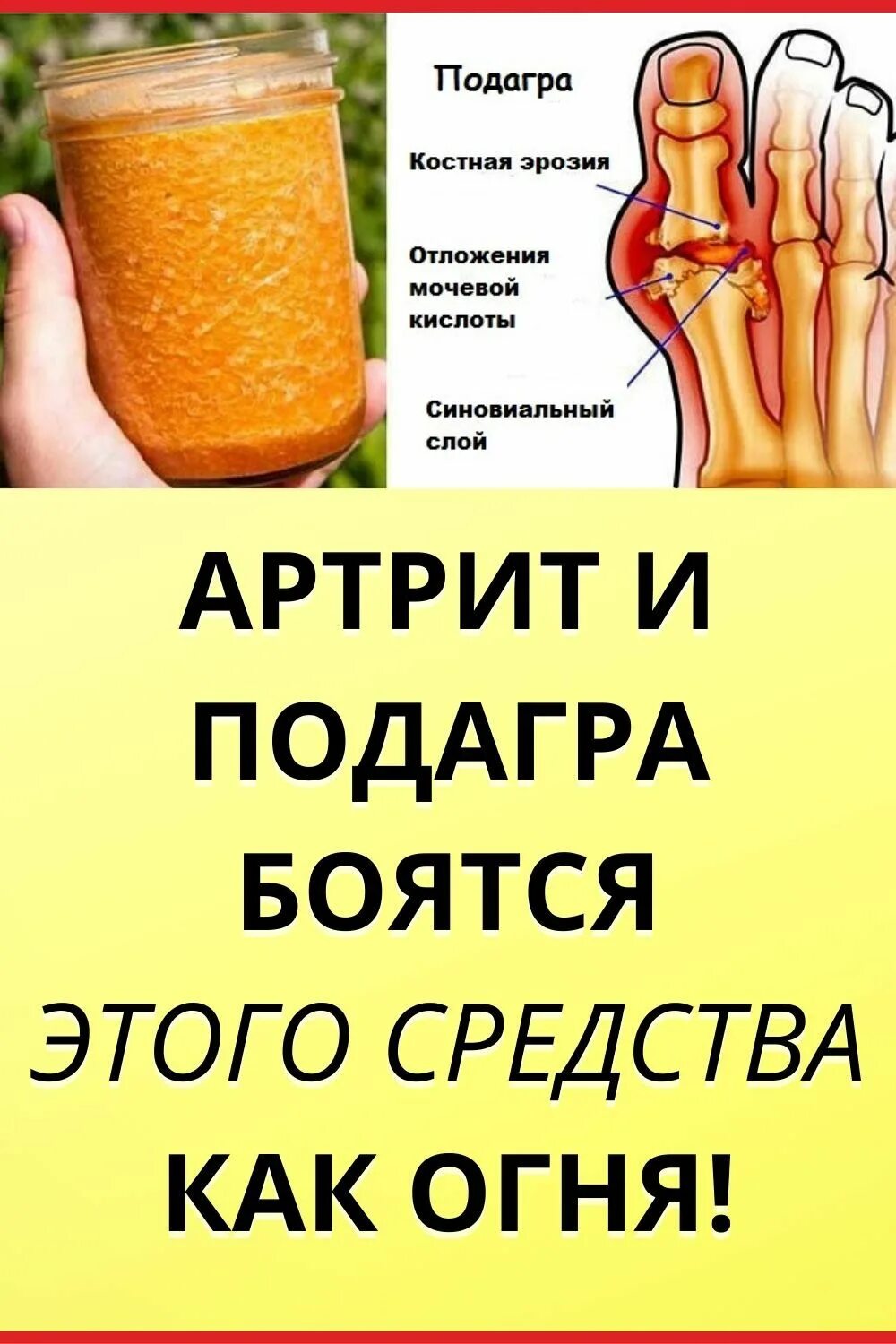 Лечение артрита пальцев народными средствами. Народные средства подагры. Подагра лекарства народные средства.