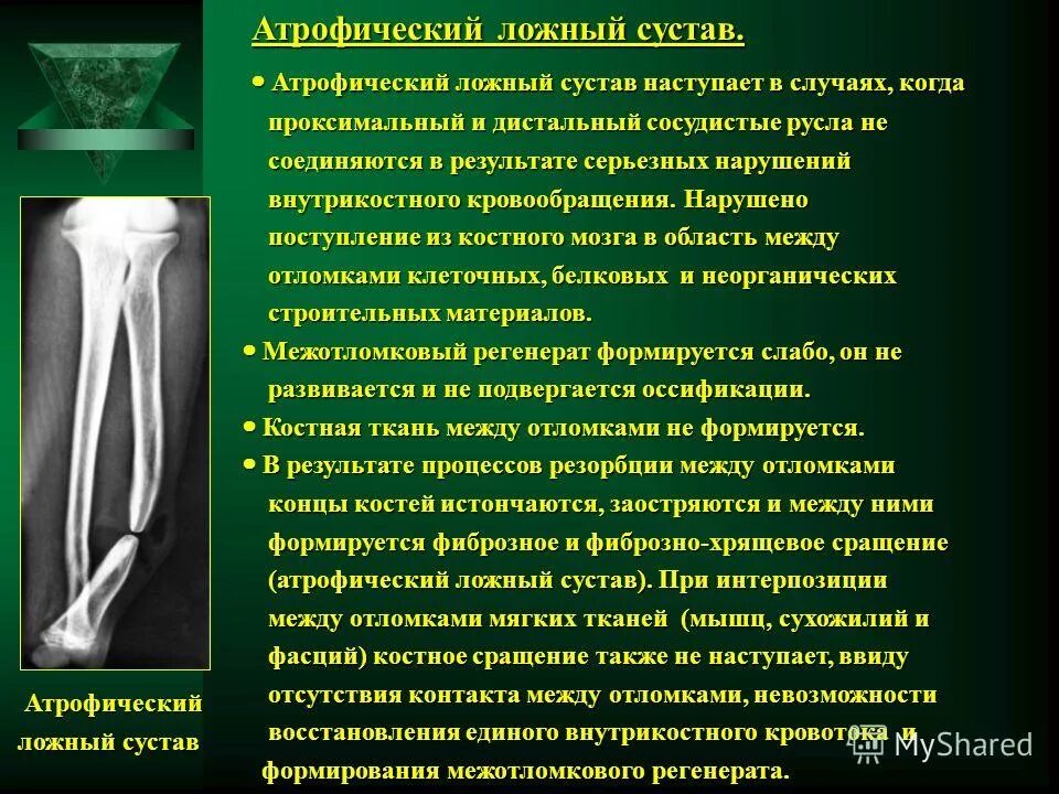 Ложный сустав большеберцовой кости. Причины образования ложных суставов:. Ложный сустав бедренной кости. Ложный сустав в лучезапястном суставе. Причина ложного сустава.