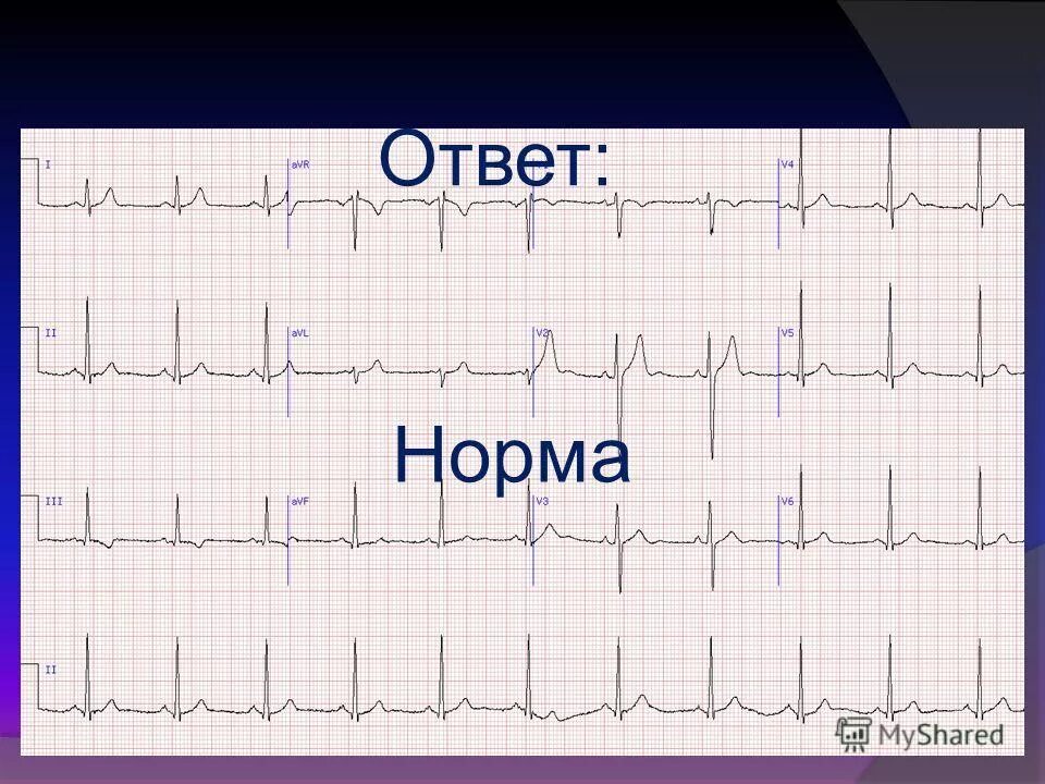 норма экг в отведениях v1 v2. нормальная экг. экг нормального человека. как выглядит экг здорового человека. нормальный экг здорового человека.