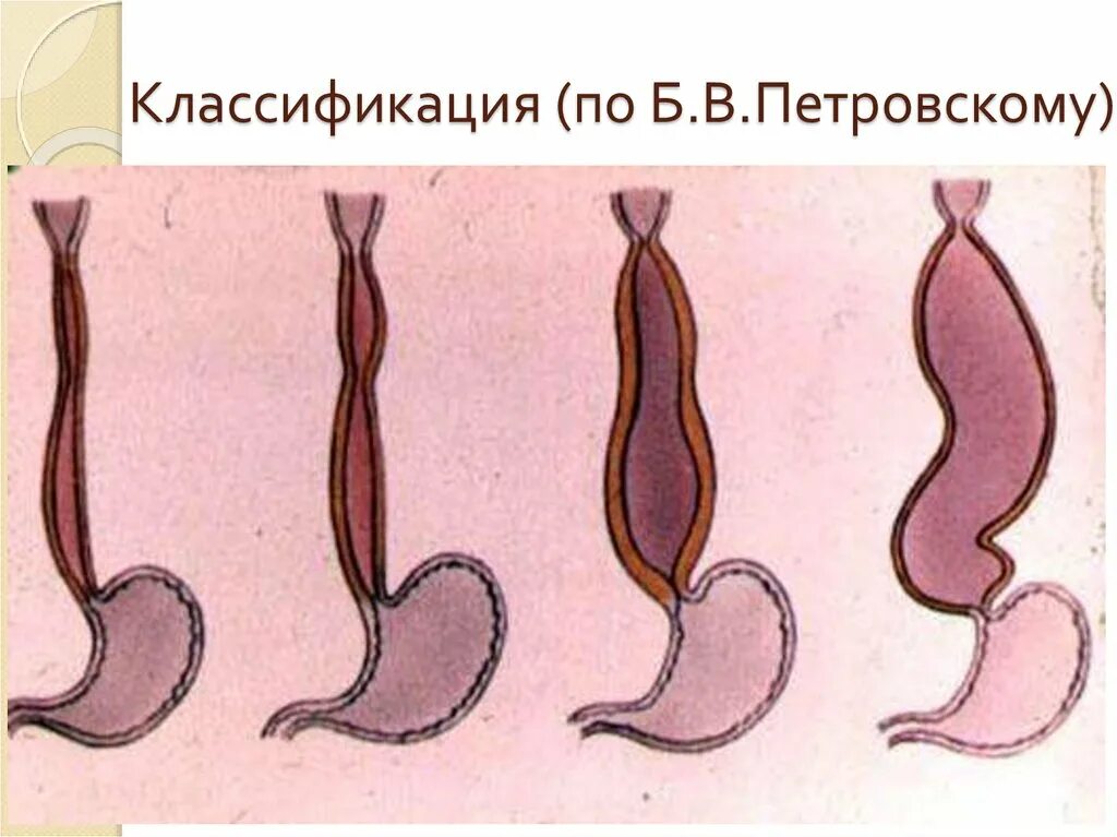 Степени расширения пищевода. Ахалазия кардии и кардиоспазм. Ахалазия кардии пищевода. Ахалазия кардии пищевода классификация.