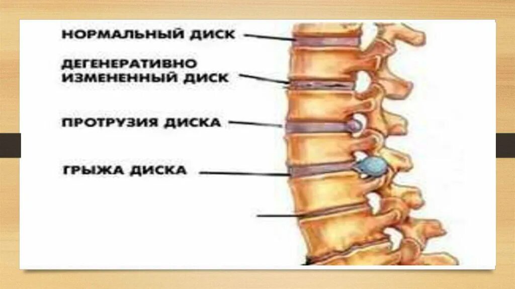 Протрузии дисков th3-th4. Протрузия межпозвонкового диска th7/th8.. Протрузии th6-7. Протрузия th9-th10 диска.