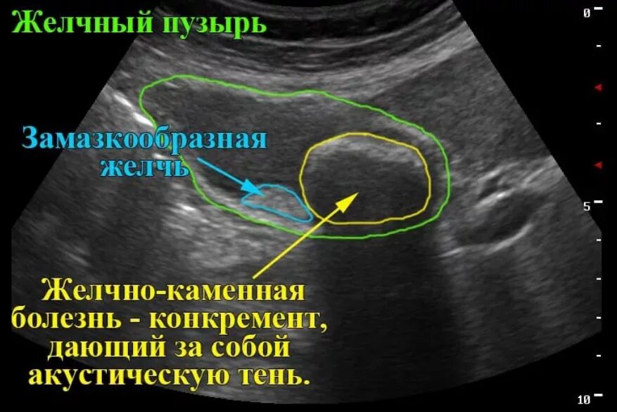 Узи сократимости желчного пузыря