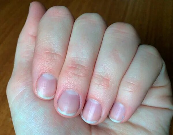 От чего синеют ногти. От чего синеют ногти
