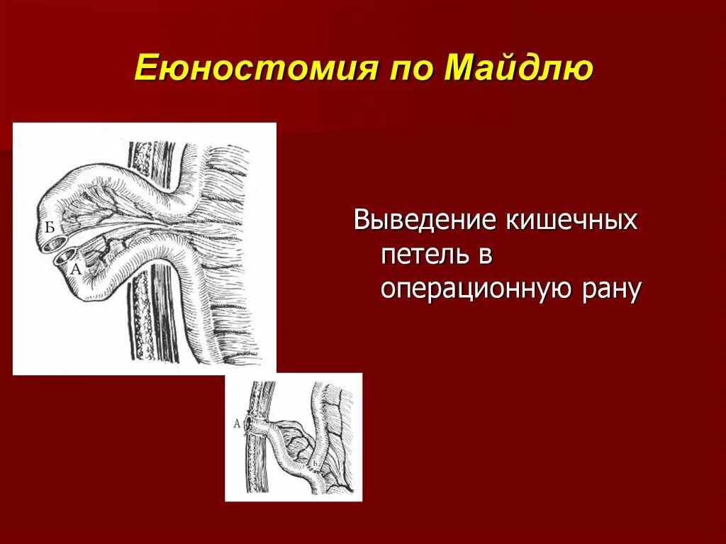 Еюностома это