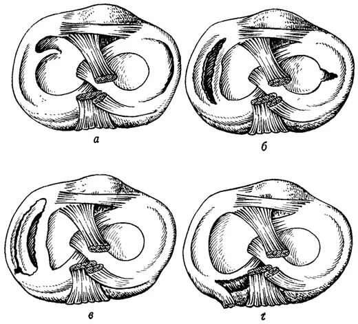 Горизонтальный разрыв заднего рога мениска. Разрыв рога мениска коленного сустава. Разрыв заднего рога медиального мениска Stoller 3 a. Повреждения менисков Столлер. Повреждение переднего рога