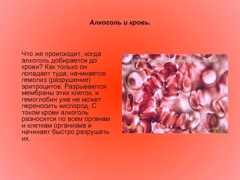 Воды попали в кровь. Алкоголь разжижает кровь или нет. Алкоголь разжижает кровь или Сгущает кровь. Влияние этанола на кровь. Болезни разрушающие эритроциты.