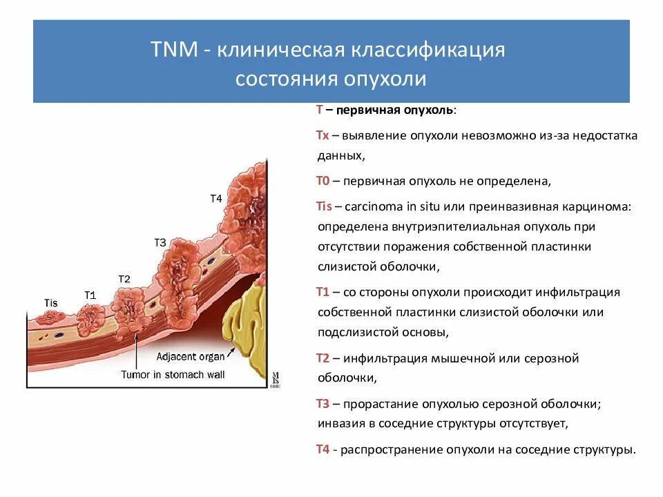 Рак желудка 4 сколько живут. Опухоль желудка классификация TNM. Клиническая классификация опухолей по стадиям. Опухоли желудка классификация ТНМ. Классификация TNM онкология.