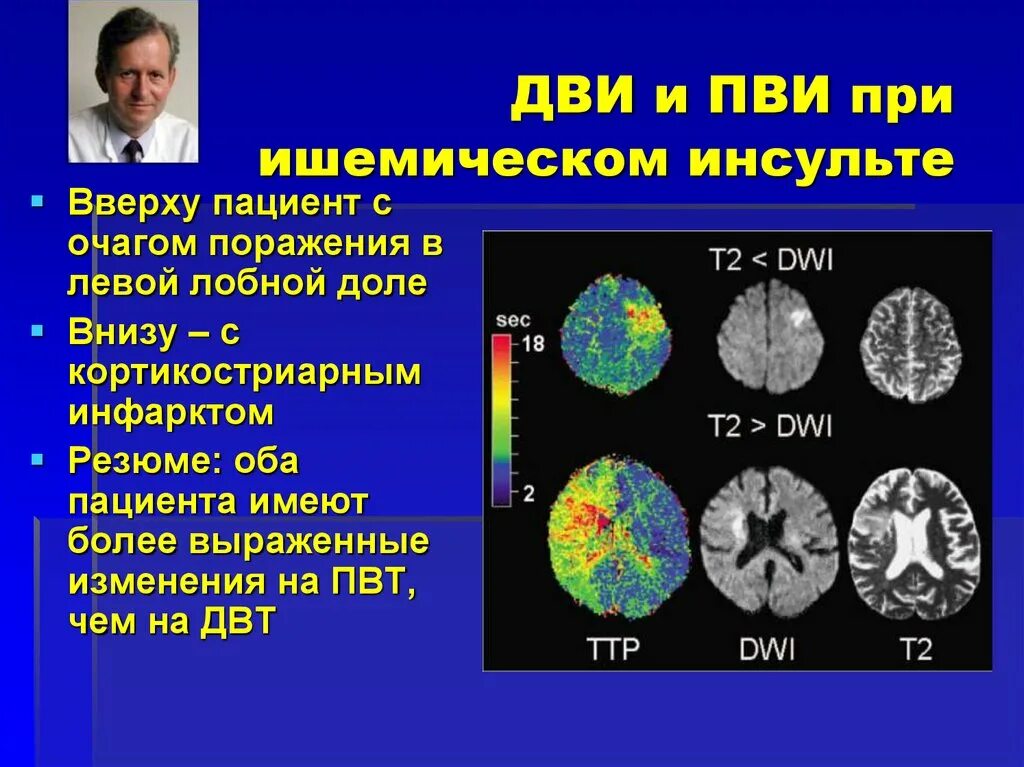 Диффузные нарушения мозга. Ишемический инсульт поражение лобной доли. Ишемический инсульт Dwi. Кт головного мозга при ишемическом инсульте. Ишемический инсульт очаг поражения.