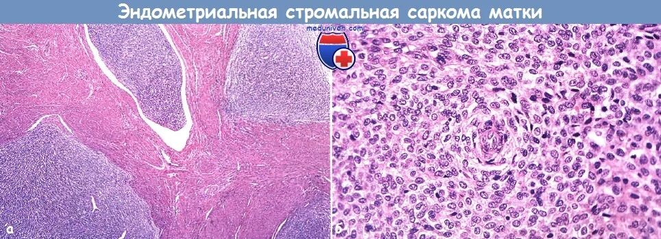 Эндометриальная стромальная саркома. Стромальная саркома эндометрия гистология. Круглоклеточная саркома гистология. Эндометриальная опухоль. Эндометриальная стромальная саркома матки гистология.