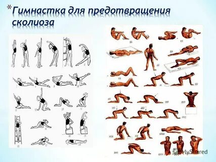 Физические упражнения при сколиозе