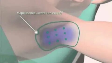 Колоть подмышки