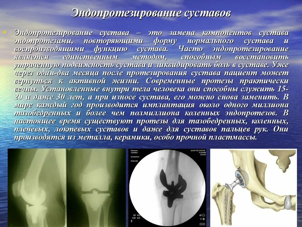 Мрт после эндопротезирования. Нестабильность эндопротеза тазобедренного сустава кт. Эндопротеза коленного сустава. Компоненты эндопротеза коленного сустава. Нестабильность компонентов эндопротеза коленного сустава.