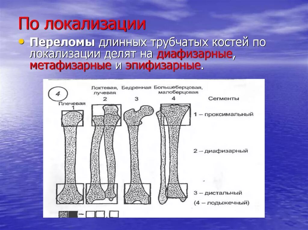 Типы закрытых переломов. Классификация переломов трубчатых костей. Основной симптом при переломе трубчатой кости. Перелом трубчатых костей симптомы.  По локализации: эпифизарные, метафизарные и диафизарные переломов.