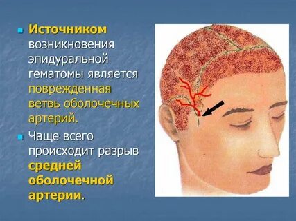 Гематомы черепа
