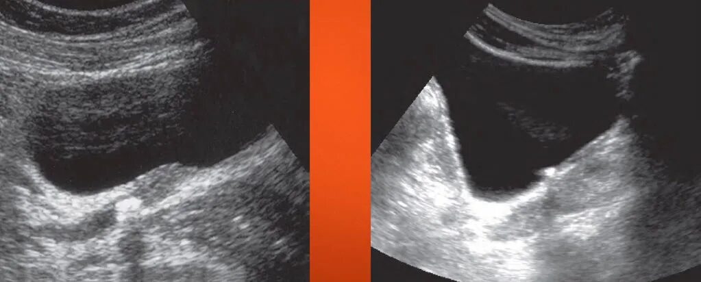 Камень в устье мочеточника 5 мм. Устье мочеточника на узи. Камень в устье. Камень в устье. Узи мочевого пузыря устье мочеточника.