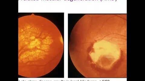 Age related macular degeneration