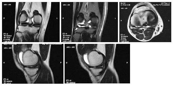 Мрт разрыв заднего рога мениска. Повреждение мениска коленного сустава мрт. Повреждение мениска коленного сустава мрт. Разрыв мениска коленного сустава на мрт. Мрт мениска коленного сустава.