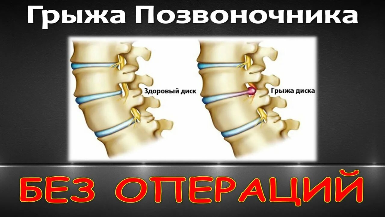 Межпозвоночная грыжа лечение отзывы