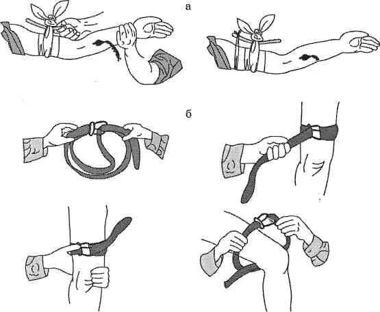 Остановка кровотечения накладывание жгута;. Техника остановки артериального кровотечения с помощью жгута. Наложение кровоостанавливающего жгута схема. Порядок наложения давящей повязки и кровоостанавливающего жгута.