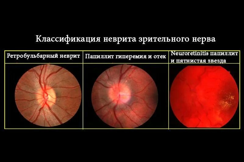 Рассеянный склероз поражение зрительного нерва. Патогенез ретробульбарный неврит зрительного нерва. Оптический неврит папиллит. Клиника ретробульбарного неврита зрительного нерва.