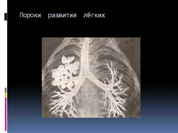 Стадии развития легких. Агенезия и аплазия легкого. Пороки развития легких рентген. Агенезия легкого рентген. Врождённые пороки лёгких.