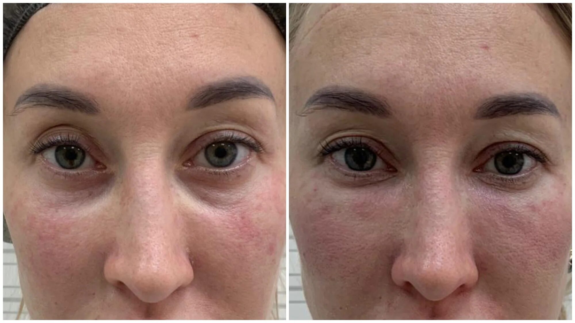 Эндоскопическая подтяжка лба и бровей. Плазмолифтинг вокруг глаз до и после. Плазмолифтинг под глаза. Мезоботокс вокруг глаз. Плазма джет блефаропластика.