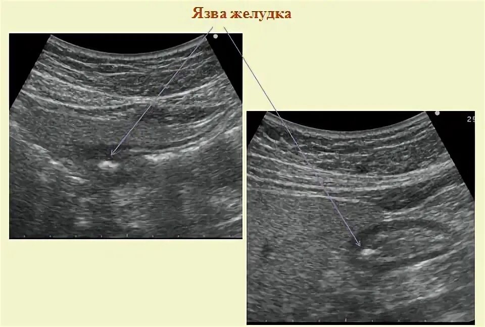 Узи желудка что показывает. УЗИ при перфоративной язве. УЗИ перфорация язвы желудка. Прободная язва желудка УЗИ. Перфоративная язва желудка УЗИ.