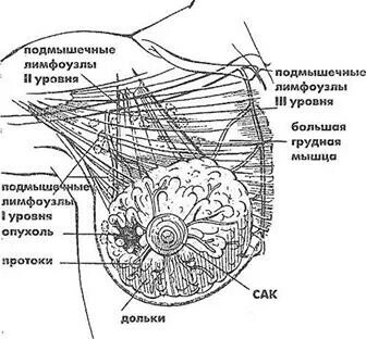 Схема расположения лимфоузлов подмышками. Лимфоузел в подмышечной впадине у мужчины. Лимфоузел в подмышечной впадине у мужчины. Подмышечные лимфоузлы воспаление. Что такое гидраденит гидраденит.