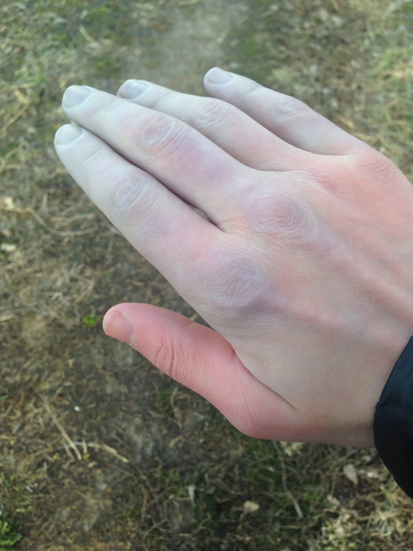 Почему рука не жала. Акроцианоз синдром Рейно. Цианоз пальцев болезнь Рейно. Синюшность пальцев болезнь Рейно.