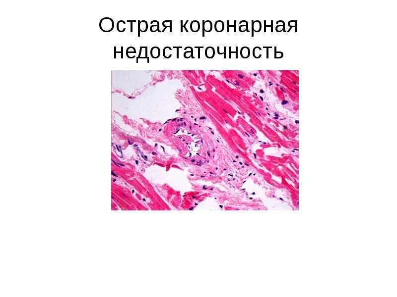 Недостаточность коронарная острая 124. Ибс острый коронарный синдром. Недостаточность коронарная острая 124. 8 что это. Острой сердечной недостаточности презентация.