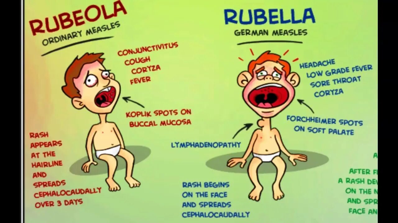Знаки кори. Вирусная инфекция розеола у детей.