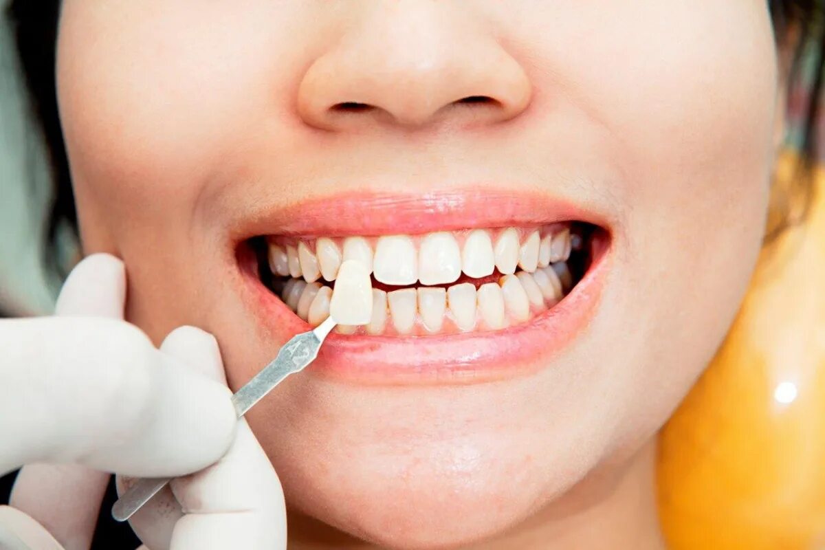 Сколько по времени делают зубы. Стоматологические виниры. Красивые зубы.