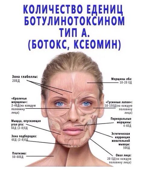 Сколько единиц ботокса в лоб. Схема ботокса на лице. Схема введения ботокса. Точки введения ботокса схема. Схема введения диспорта на лице.