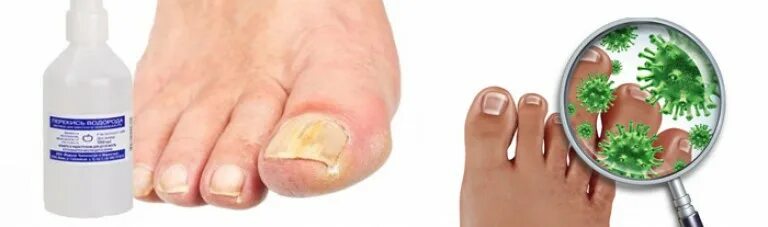 Грибок ногтей на ногах лекарство. Перекись водорода от грибка ногтей. Перекись водорода ногти на ногах. Грибок стопы ванночки для ног. Обработка грибковых ногтей на ногах.