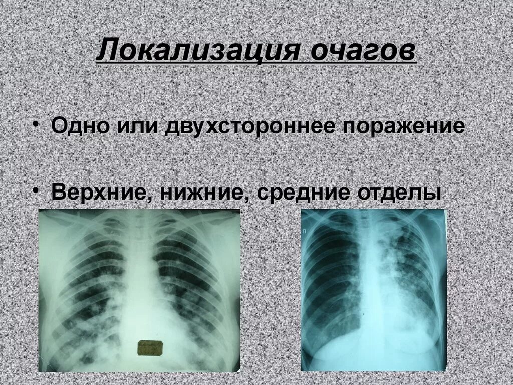 Очаговое поражение легких. Очаговая диссеминация рентген. Очаговая диссеминация легких рентген. Очаги диссеминации в легких. Очаги и ограниченные очаговые диссеминации.