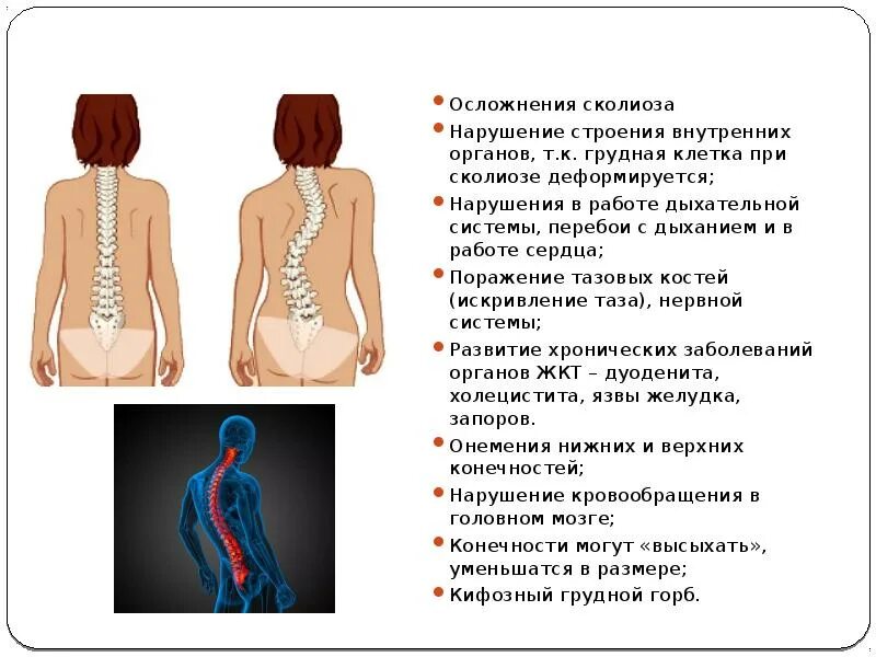 Сколиотическая деформация грудного отдела позвоночника. Боли при сколиозе грудного. Сколиоз 3 степени осложнение. Боль в спине. Сирингомиелия грудного отдела позвоночника мрт.