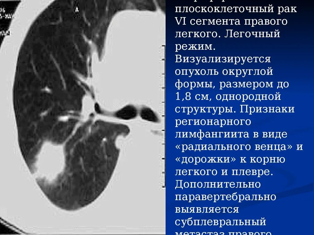 Переферический очаг правого легкого. Периферические опухоли легких. Периферическое новообразование в легких. Признаки периферического легкого