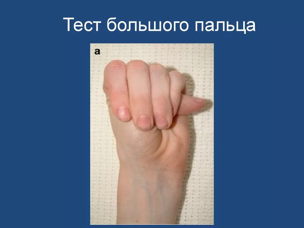 Тест большой палец ладонь. Тест запястья и большого пальца. Тест большого пальца ДСТ.
