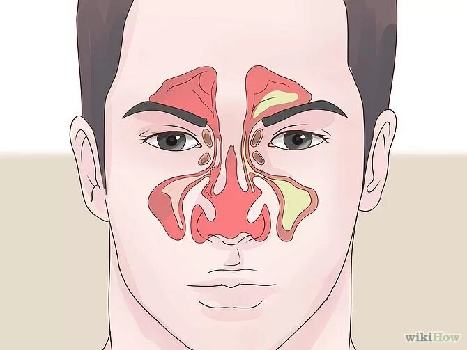 Затяжное заложенность носа. Строение носа при насморке. Заложенность носа без насморка.