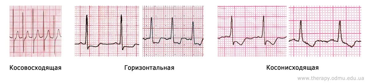 Депрессия сегмента st. Депрессия и элевация сегмента St. Элевация ст на ЭКГ. Косонисходящая депрессия сегмента St в v4-v6. Косовосходящая депрессия St на ЭКГ.