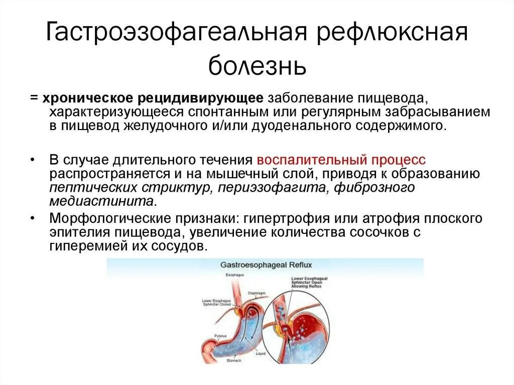 Рефлюкс какие симптомы. Гастроэзофагеальная рефлюкс болезнь. газоэзофагальнаярефлюксная болезнь. гастроэзофагеальной рефлюксной болезн.