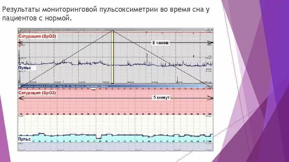 Пульсоксиметрия показатели. Показатели пульсоксиметрии. результаты пульсоксиметрии. пульсоксиметрия показатели нормы. интерпретация результатов пульсоксиметрии.