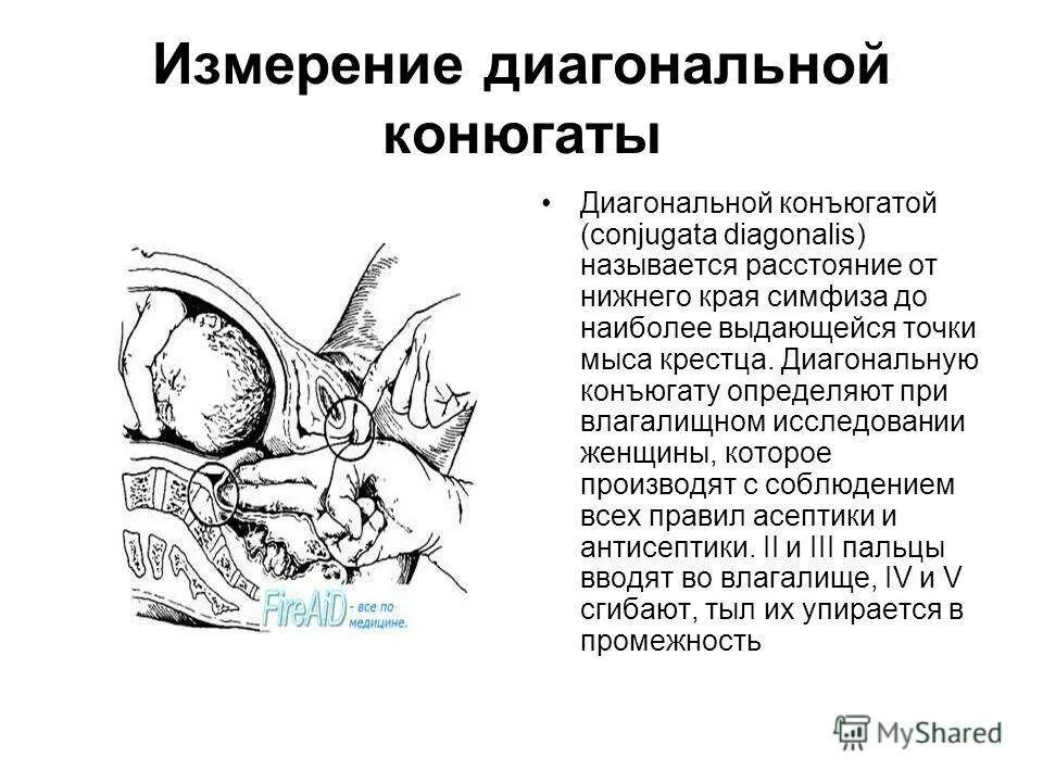 Головка при тазовом предлежании