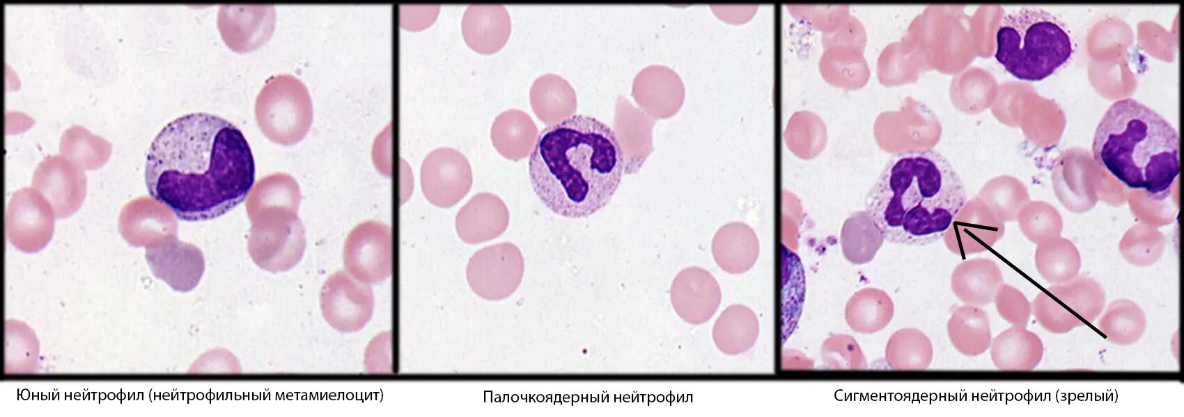 Нормы в анализе крови нейтрофилы сегментоядерные. Нейтрофильные метамиелоциты. Палочкоядерные у кошек. Измененные лимфоциты. Палочкоядерные у кошек.