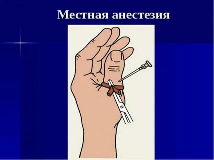 Местный наркоз как делают