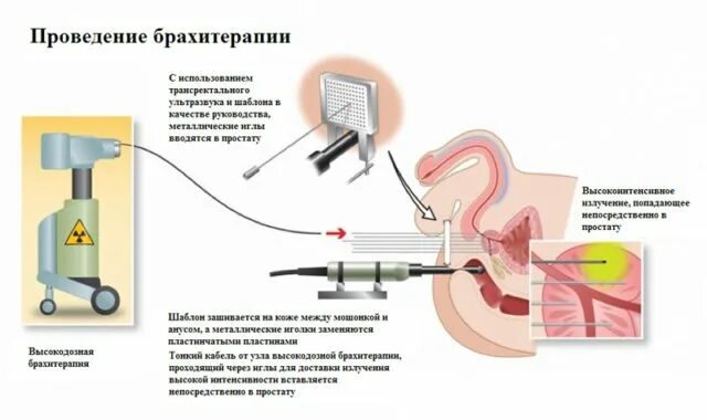 Реабилитация предстательной железы. Вибромагнитолазерная терапия простаты. Аппарат для брахитерапии Гаммамед. Вибромагнитолазерная терапия предстательной железы аппарат. Брахитерапия предстательной железы.