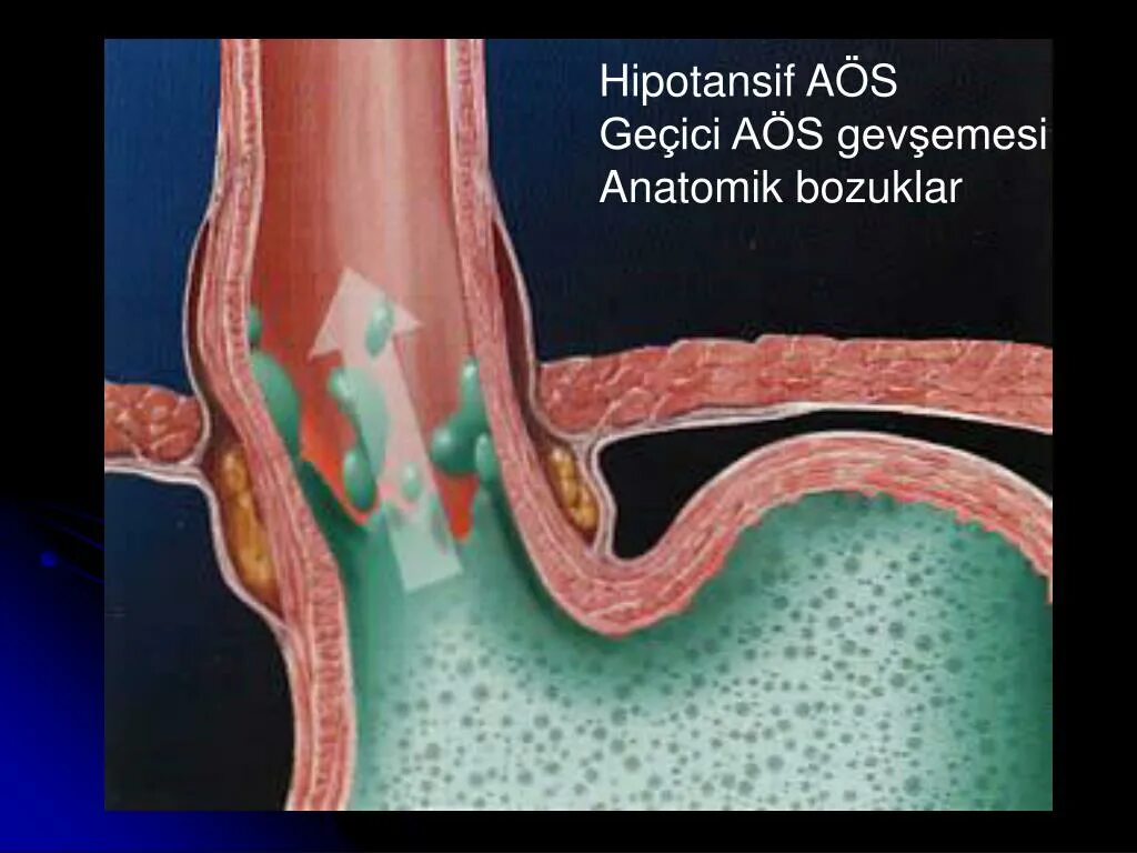 Рефлюксная болезнь сфинктер. Рефлюкс эзофагит слюноотделение. Как избавиться от рефлюкса. Рефлюксная болезнь сфинктер. Гастро-эзофагальный рефлюкс симптомы.
